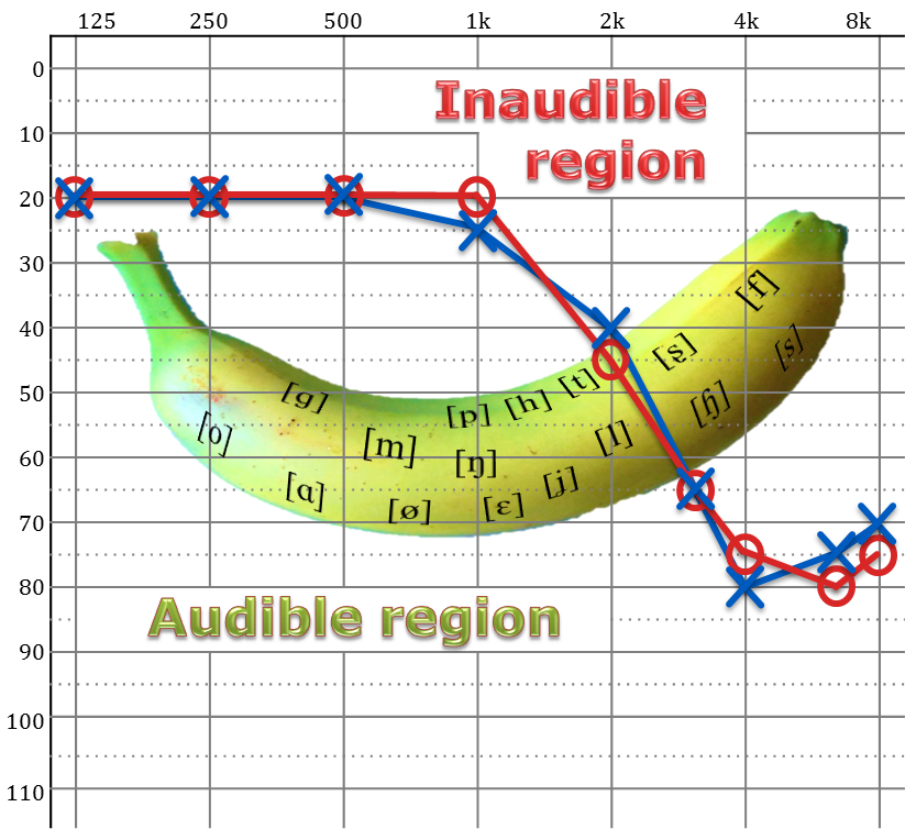 Image of the Speech Banana in an audiogram showing a common hearing loss